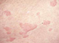 Phản ứng phụ thường gặp của thuốc kháng sinh 