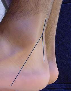 Hiểu đúng công và tội của statin