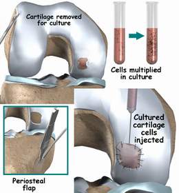 Bước ngoặt lớn trong điều trị thoái hóa khớp