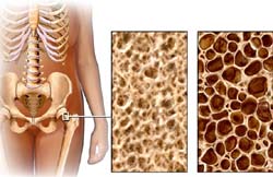 Coi chừng dược phẩm gây loãng xương
