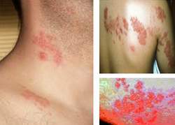 Thuốc trị “giời leo”